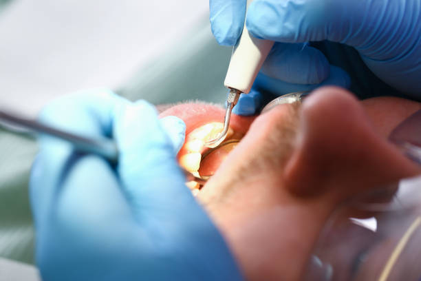 Best Emergency Tooth Extraction in Middleton, WI
